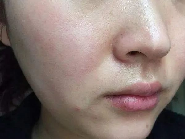 【矿建提醒】口罩戴久了闷痘,过敏,压迫难受?皮肤科专家建议请收好.